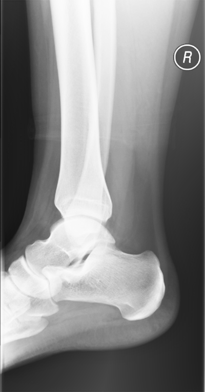 x-ray image of an adult right ankle