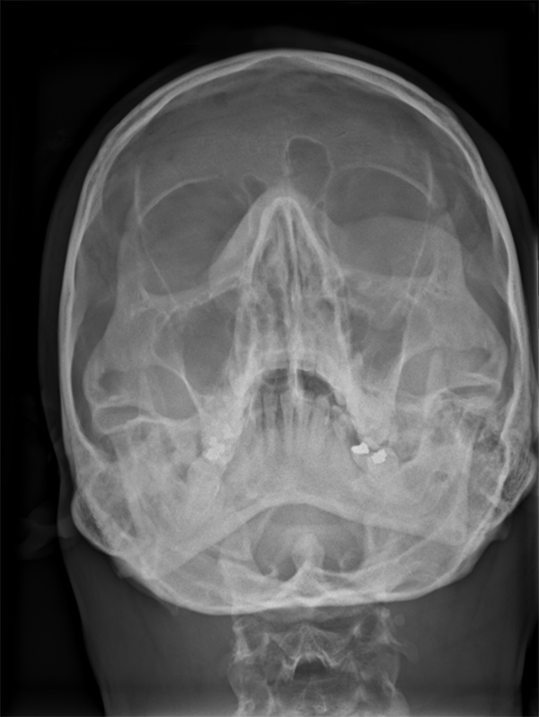 x-ray image of a human skull